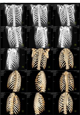 醫(yī)用ct膠片-黑白胸骨