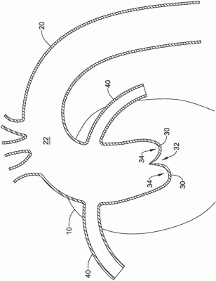 經(jīng)導(dǎo)管主動(dòng)脈瓣膜系統(tǒng)EVOLUTPRO-23-US