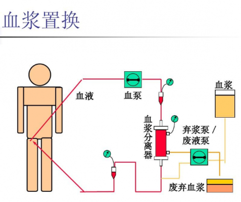 血漿置換用管路multifiltratepro tpe