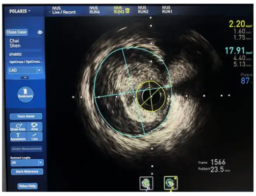 血管內(nèi)超聲影像處理軟件into ivus