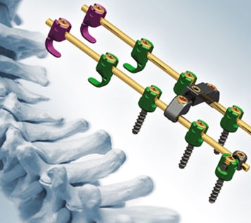 斯潘威椎板固定板系統(tǒng)