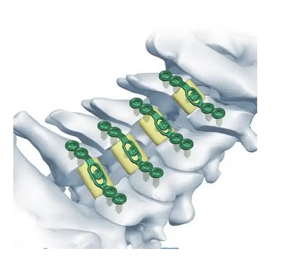 正天椎板固定板系統
