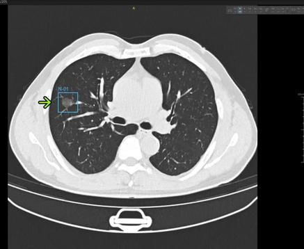 肺結(jié)節(jié)ct影像輔助分診軟件